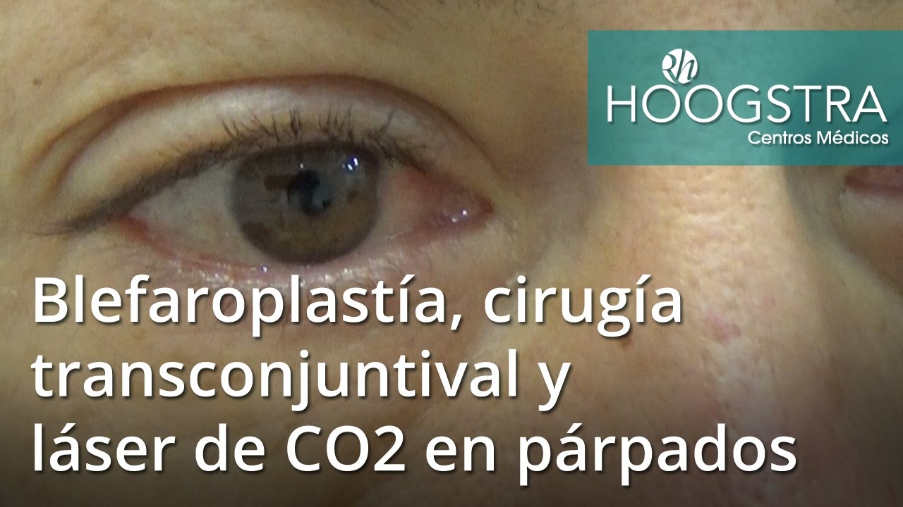 eyelid surgery Blefaroplastía, cirugía transconjuntival y láser de CO2 en párpados (16122)