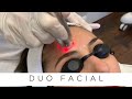 Duo Facial | Radiofrequency Skin Tightening