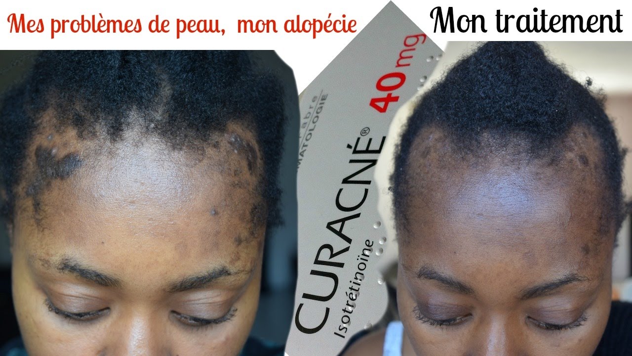 ALOPECIE I Mes problèmes de peau/mon traitement CURACNE