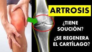 đź”´ ARTROSIS | SĂŤNTOMAS, CAUSAS, TRATAMIENTO Y RECOMENDACIONES đź”´ ARTROSIS | SĂŤNTOMAS, CAUSAS, TRATAMIENTO Y RECOMENDACIONES