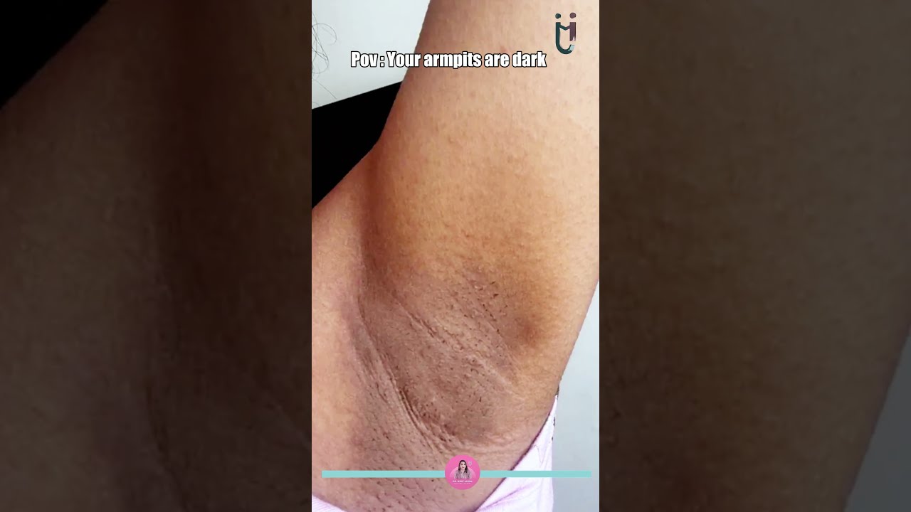 Dark Underarms Treatment | Dermatologist | Dr. Israt Jahan |