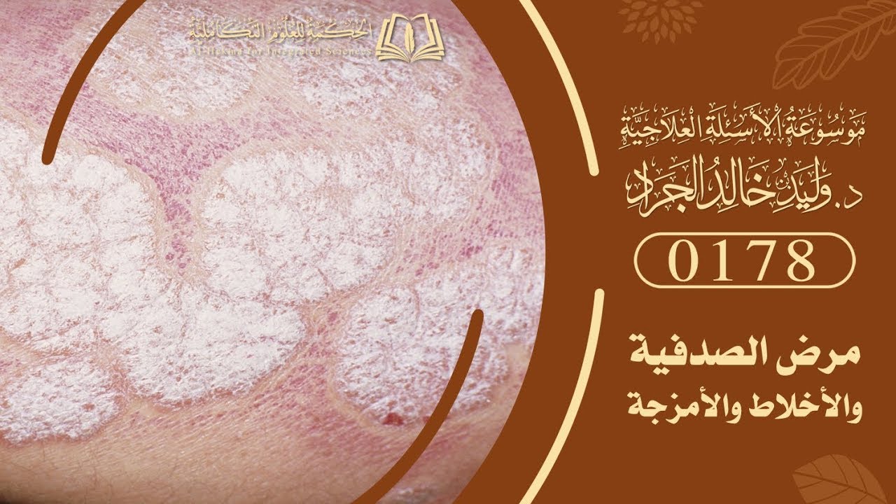 السؤال [178] [10-2]: جاءنا شخص يشكو من الصدفية وهو من الأمراض المشتركة في عدة أخلاط ...؟