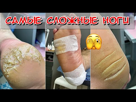 Самые сложные ноги / Кератоз пяток / Огрубевшие пятки / Трещины на пятках / Педикюр