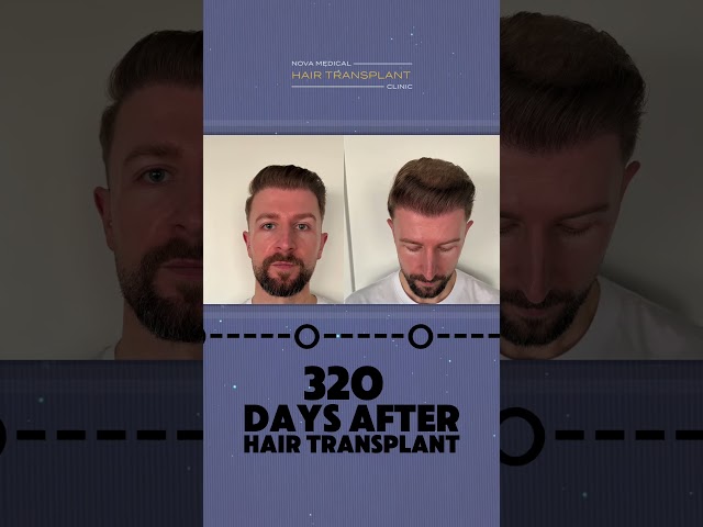 You waited 12 months for this… and the #hairtransplantbeforeandafter is finally here. 🔥