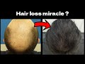 This Treatment Will Revolutionize Hair Loss Management In 2026