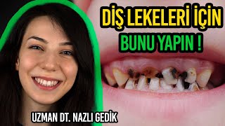 ÇOCUKLARIN DİŞLERİNDEKİ LEKELER NEDEN OLUŞUYOR ? - Uzm. Dt. Nazlı Gedik (Çocuk Diş Hekimi)