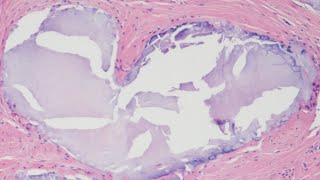 Quiz 8 - Urological Pathology screenshot 5