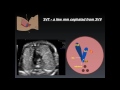 Three Vessel Tracheal View  A Review of Normal and Abnormal Findings