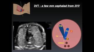 Three Vessel Tracheal View  A Review of Normal and Abnormal Findings
