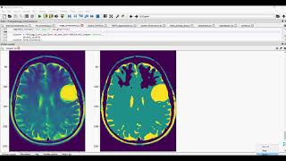 Brain Cancer Gui Classification in Python
