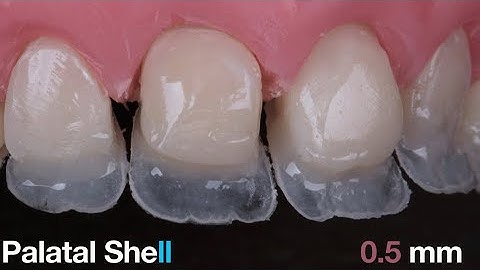Tips series 1 : How to make palatal Shell using silicone index ?
