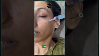Open Pores, Acne Scars &amp; Bumpy Skin Treatment | Smooth Skin Solution | Asthederm Mohali