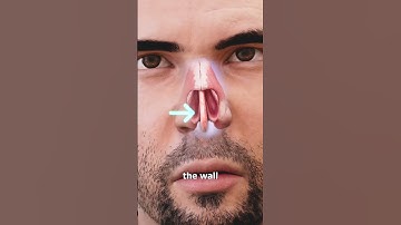 Thumbnail of Picking Your Nose Can Cause a Hole 😨