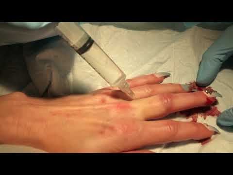 Digital block for repair of a finger laceration