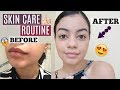 HOW TO GET RID OF ACNE &amp; SCARS! Best Skin Care Routine EVER!