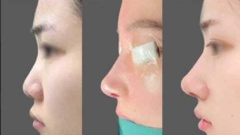 Bác sĩ Tú Dung NÂNG MŨI S LINE 3D có thật sự ĐẸP NHƯ LỜI ĐỒN?