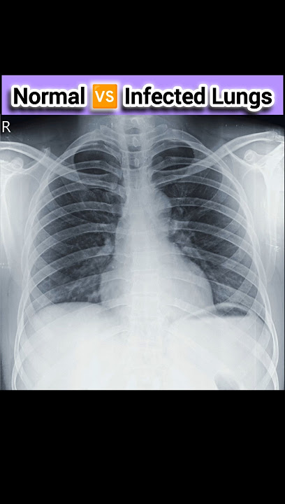 Normal 🆚 Infected Lungs#gamcamedical