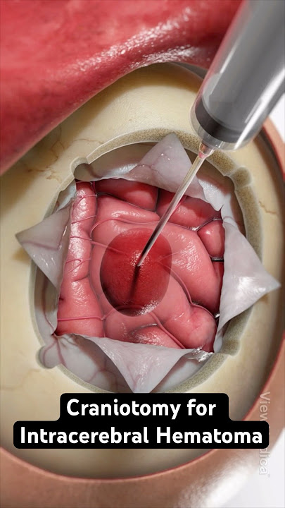Removing pooled blood from the brain (3D Animation)
