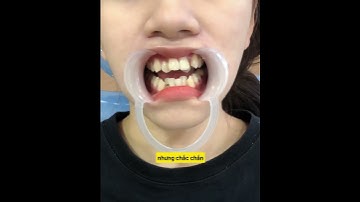 Răng Khấp Khểnh Không Thể Làm Răng Sứ #rangsu #rangkhapkhenh  #rangsuthammy
