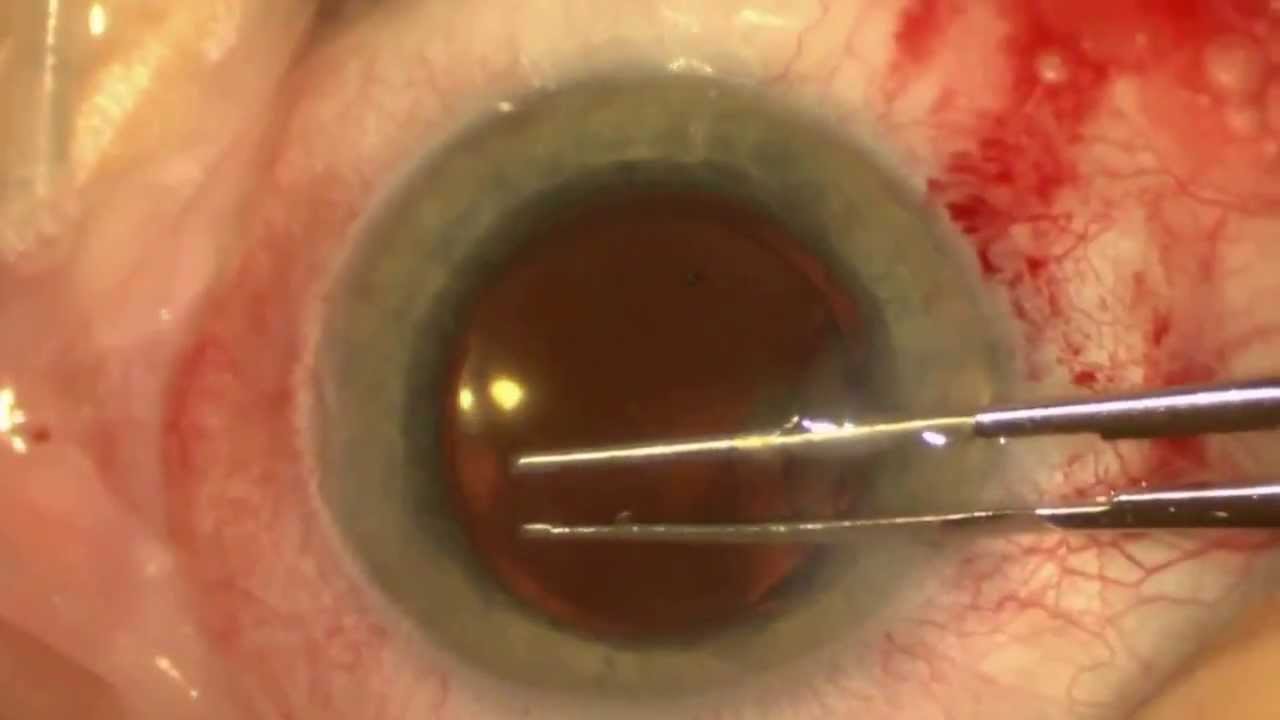 DSAEK Corneal Transplantation Triple Procedure at Duke Eye