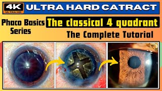 Ultra Hard Cataract Demonstrating The 4 Quadrant Technique Phaco Basics - Dr Deepak Megur