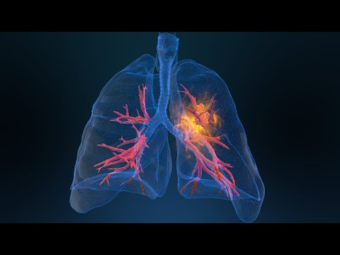 Young women being diagnosed with lung cancer at higher rates than young men