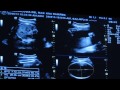 Ultrasound Scan of a Baby Boy at 31 Weeks