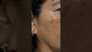 This Laser ELIMINATES Melasma