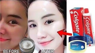 Applied Toothpaste And Vaseline On My Face At Night For 5 Minutes Watch What Happened After