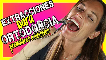 ¿Por qué los ortodoncistas extraen los dientes para los aparatos?