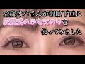52歳オバさんが眼瞼下垂に皮膜式のふたえのりを使ってみました