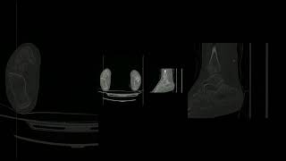 Тарзальная коалиция. Рентгенология. МРТ.
