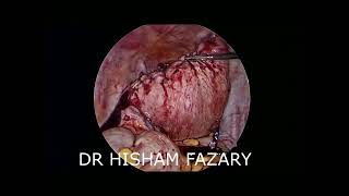 استئصال ورم ليفى ضخم بالمنظارHuge myoma, laparoscopic myomectomy (18 cm)