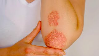 Understanding Psoriasis: Why Patches Grow and How to Treat Them
