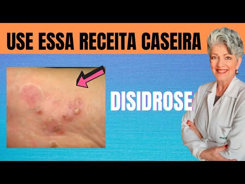 Cuide da Disidrose com  essa Receita Caseira