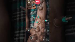 Cupping therapy | hizama Cuppiy tretment | #backpain #painrehabb #shortsfeed #cuppingtherapy