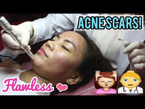 HOW TO GET RID OF ACNE SCARS | Fractional Needling Therapy at Flawless