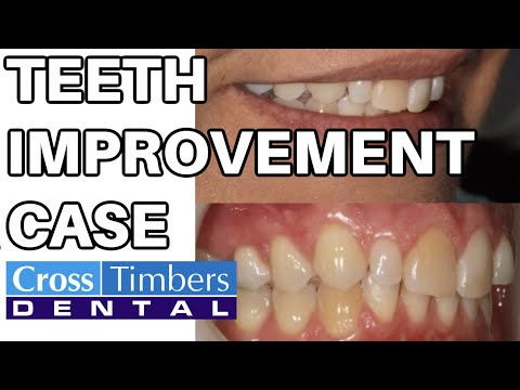 Case of the Week: Teeth improvement