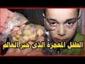 الطفل الذي حير الاطباء يخرج زلط من عينيه