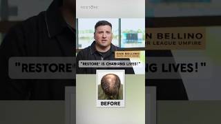 Are MLB Umpires Getting Hair Transplants? ⚾