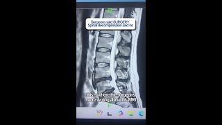 Spinal Decompression Cured Disc Herniation & Sciatica Without Surgery – Full Recovery #Spine