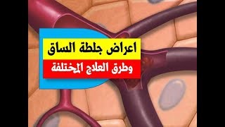 اعراض جلطة الساق العميقة وطرق العلاج المختلفة | اعراض الجلطة وطرق علاجها