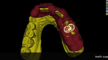 Fully Guided Socket Shield Technique