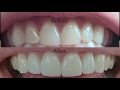 Dental Veneers Procedure Overview