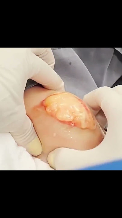 Check Out This Blob Lipoma on the Arm!