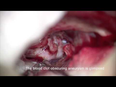 Clip Repair Of Anterior Cerebral Artery Blister Aneurysm