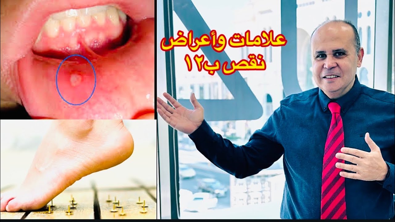 ١٠علامات تحذيريه تدل علي نقص فيتامين ب١٢👈👌لو ماتعرفش حاجه عن فيتامين ب١٢👈☝️لازم تشاهد هذه الحلقه