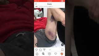 Logan Paul Pulled Hamstring Injury
