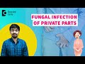 FUNGAL INFECTION OF PRIVATE PARTS| Groin Infection|Yeast Infection-Dr.Rajdeep Mysore|Doctors&#39; Circle