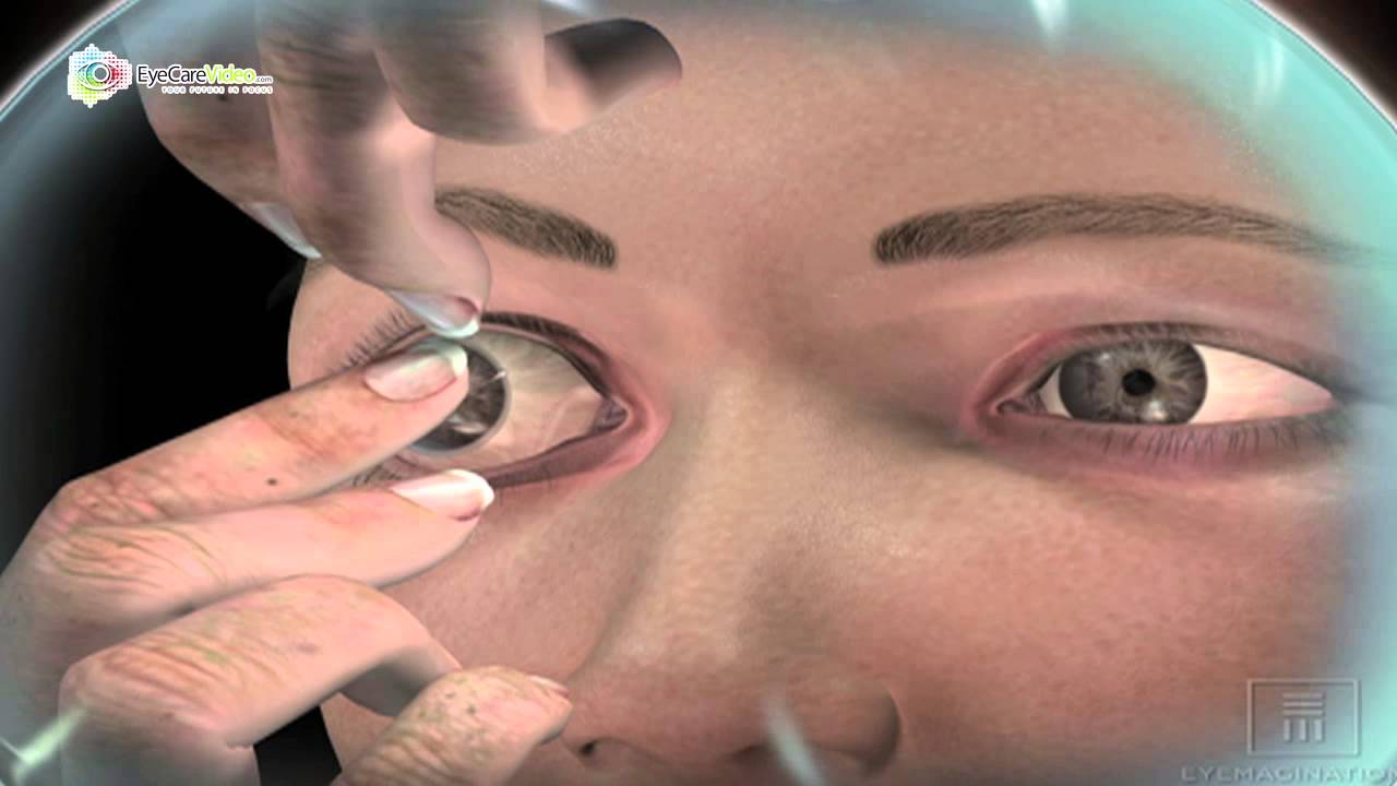 Dr. Brad Lewis - Contact Lenses